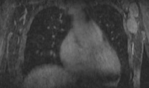 Resonancia magnética, plano coronal. Secuencia T1FL3D con contraste intravenoso. Dos adenopatías en axila izquierda de aspecto patológico.