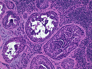 Glándulas con hiperplasia ductal usual del epitelio. Nótese la presencia de células mioepiteliales.
