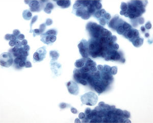 Extensión de material procedente de la punción de un carcinoma procesado con citología líquida. Destaca el fondo limpio de la preparación y la disposición en monocapa de las células (Papanicolaou, ×40).
