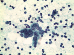 Extensión con linfocitos y células epiteliales tumorales correspondientes a la punción de un ganglio axilar metastásico (Papanicolaou, ×40).
