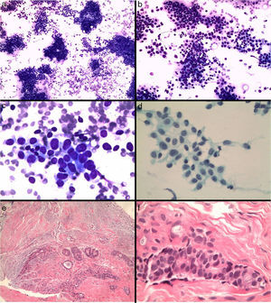 Fibroadenoma diagnosticado erróneamente de carcinoma. a y b) Extensiones citológicas muy celulares con células epiteliales que se disponen en placas y aisladas (Diff-Quick, ×10 y ×20). c) Células de núcleo grande, con nucléolo y alteración de la relación núcleo/citoplasma (Diff-Quick, ×40). d) Placa de células epiteliales con tendencia a la dehiscencia (Papanicolaou, ×40). e) El estudio histológico de la lesión muestra un fibroadenoma (hematoxilina-eosina, ×4), f) con marcada atipia del componente epitelial (hematoxilina-eosina, ×40).