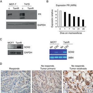 Mayor contenido de CSC en células resistentes a tamoxifeno. A. Análisis por Western blot de los niveles de expresión del receptor de progesterona (PR) en células MCF-7 y T47D parentales (c) o resistentes a tamoxifeno (TamR). GAPDH es el control de carga. B. Niveles de expresión de PR a nivel de ARN en células adherentes (barra gris) o en mamoesferas durante varios días en cultivo (barras negras). C. Análisis de los niveles de Sox2 por Western blot (izquierda) o ARN (derecha) en células CSC con fenotipo CD44+CD24−/low o no stem. GAPDH y 36B4 se emplearon como controles en cada caso. D. Estudio por inmunohistoquímica de la expresión de Sox2 en muestras de cáncer de mama ER-positivo. Izquierda, ejemplo representativo de muestra de tumor que respondió al tratamiento hormonal («Responde»); centro, ejemplo de muestra del tumor primario de una paciente que no respondió a tamoxifeno («No responde. Tumor primario); derecha, ejemplo de muestra de la recidiva desarrollada después del fallo de la terapia hormonal («No responde. Tumor recidivado»).