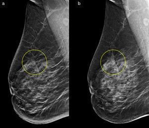 Distorsión arquitectural vista en a)imagen sintetizada y b)mamografía digital. En la imagen sintetizada la distorsión se objetiva de forma más clara que en la imagen 2D.