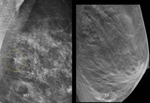 Paciente asintomática de 52 años. En la proyección oblicua mediolateral de la mama izquierda se identificó una posible imagen de distorsión (círculo). El estudio de TS resultó normal, ya que se trataba de una superposición tisular.