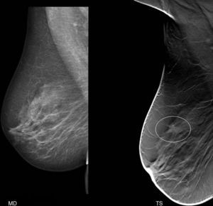 Paciente de 58 años que acudió para revisión preventiva. En el estudio convencional no se apreciaron alteraciones destacables. Sin embargo, en la TS se identificó un nódulo espiculado de 8mm. La biopsia demostró un carcinoma ductal infiltrante.