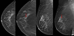Distorsión arquitectural a las 12h de la mama derecha, identificable exclusivamente en el estudio de tomosíntesis (flechas). Histología: carcinoma tubular sobre cicatriz radial.