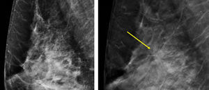 Nódulo espiculado, altamente sospechoso de malignidad, objetivable en el estudio de tomosíntesis (flecha) y no en la mamografía convencional. Histología: carcinoma ductal infiltrante.