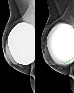 Distorsión arquitectural asociada a microcalcificaciones identificable en el estudio de tomosíntesis (flecha) y no en el estudio de mamografía convencional, en mujer portadora de prótesis mamaria. Histología: carcinoma ductal infiltrante.