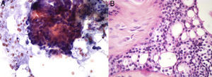 Citología convencional (A) de una lesión diagnosticada como carcinoma que en la histología (B) fue un fibroadenoma con focos de hiperplasia intraductal no atípica.