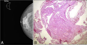A) Imagen radiológica del tumor en mama derecha. B) Imagen microscópica del tejido glandular tiroideo en mama derecha con nódulos encapsulados y folículos tiroideos en su interior.