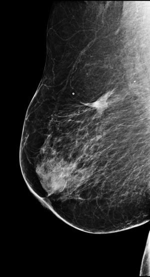 Paciente diagnosticada de carcinoma ductal infiltrante de 13mm y sometida a RFA a los 78 años, sin tratamiento quirúrgico posterior. Mamografía de seguimiento realizada 5 años más tarde. Se observa únicamente una densidad asimétrica residual, correspondiente a necrosis grasa.