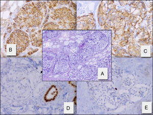 A (HE, ×10): tejido mamario con extensa fibrosis colagenizada (A) que atrapa adipocitos maduros (B) y que se encuentra infiltrado por un carcinoma que forma nidos sólidos cohesivos (C). B-E (IHC, ×20): el estudio inmunohistoquímico demuestra positividad de las células neoplásicas para cromogranina (B), sinaptofisina (C), positividad débil para receptores de progesterona (D) y negatividad para estrógenos (E).