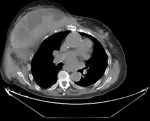 Tomografía computarizada torácica con contraste, en la que se aprecia gran hematoma retromamario derecho (15×7×15cm).