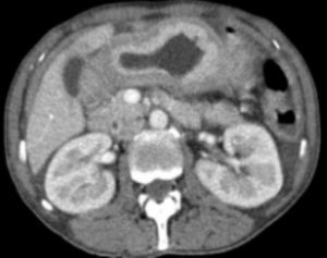 Linitis plástica de antro-cuerpo gástrico en imagen tomográfica, la anatomía patológica informó de adenocarcinoma infiltrante pobremente diferenciado ulcerado y necrosado.