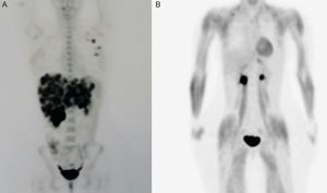 A) PET basal: multitud de focos hipermetabólicos hepáticos (SUV 13,1g/ml), foco hipermetabólico en mama izquierda CSI (4,4g/ml), adenopatía hipermetabólica e axila ixquierda (SUV 6,2g/ml), y en región subpectoral izquierda (SUV 2,7gml). B) Último PET: mejoría de las lesiones hepáticas metastásicas, quedando mínima enfermedad hepática milimétrica y resto tumoral en mama axila.