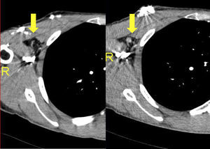 Aparición de adenopatías radiológicamente significativas en la axila contralateral en la TC después de 7 meses tras la cirugía.