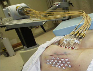 Fijación de los catéteres a la piel con botones plásticos y conexión al MicroSelectron HDR para empezar la irradiación.