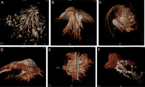 Hallazgos benignos. A) Mastopatía fibroquística. B) Galactocele. C) Quistes/galactoceles. D) Absceso subareolar fistulizado (sarcoidosis). E) Galactofoectasias. F) Proliferaciones papilares sin atipias.