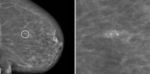 Mamografía y detalle de las microcalcificaciones agrupadas.
