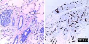 A la izquierda se muestra la tríada de Rosen: LCIS (1), cambios columnares (2) y carcinoma tubular (3). A la derecha se muestra la tinción inmunohistoquímica para citoqueranina-19.