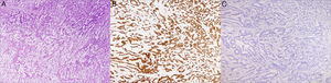 Izquierda: lesión tumoral de la mama donde se puede apreciar la amplia cantidad de material de mucina (zona central) (HE, ×40). Centro: lesión tumoral de la mama (zona periférica), con positividad nuclear para CDX-2 (monoclonal de ratón antihumano CDX-2, clon DAK-CDX-2; Dako Corp.) para la identificación de adenocarcinomas y tumores carcinoides del tracto gastrointestinal (HE, ×40). Derecha: lesión tumoral de la mama (zona periférica), con ausencia de tinción para la mamoglobina (monoclonal de ratón antihumano mamoglobina, clon 304-1A5; Dako Corp.) para la identificación del carcinoma ductal de mama (HE, ×40).