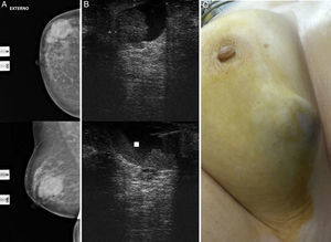 A) Mamografía derecha: imágenes nodulares superpuestas. B) Ecografía mamaria y (PAAF): nódulo heterogéneo de contenido quístico. C) Aspecto externo.