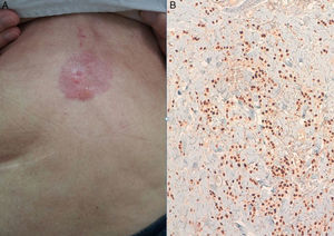 A) Imagen metástasis cutánea. B) Inmunohistoquímica que revela infiltración dermo-epidérmica de probable origen mamario.