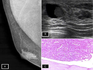 A) Nódulo retroareolar mama derecha. B) Quiste de 15mm con cápsula engrosada y crecimiento sólido en su interior (lesión papilar). C) Neoplasia epitelial tipo papilar delimitada por pared quística.