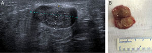 (A) Ecografía. Imagen nodular retroareolar de 23×12×24mm. (B) Miofibroblastoma. Nódulo lobulado, bien delimitado.