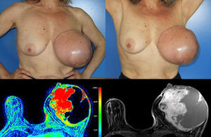 Initial presentation clinical and imagiologic (MRI) features (left breast with both cystic and solid areas, the last ones with a precocious contrast enhancement – type 2 curve).