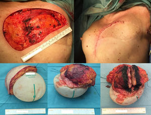 The wide excision of the local recurrence was accomplished with the partial resection of the pectoralis major and the lastissimus dorsi muscle (together with the breast implant and a segment of its capsule), in one unique piece. Closure was achieved by a local tissue advancement flap – initially corresponding to the tissue covering the lower and lateral part of the breast implant.