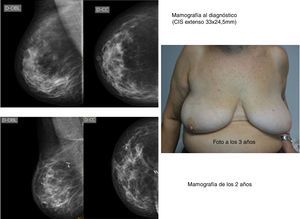 Caso clínico 1. Paciente de 58 años con diagnóstico de carcinoma in situ (CIS) extenso (33×24,5mm) en cuadrante supero externo (CSE) de la mama derecha. Intervenida en junio del 2013 (tumorectomía+BSGC) con exéresis de pieza quirúrgica de 17×9×5cm, IP VanNuys 9. A los 2 meses de postoperatorio, recibió 50Gy como tratamiento adyuvante.