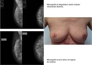 Caso clínico 2. Paciente de 50 años con diagnóstico de carcinoma ductal infiltrante (CDI) T1N0 en cuadrante ínfero externo (CIE) de la mama izquierda. Intervenida en marzo del 2011 (tumorectomía+BSGC) con exéresis de pieza quirúrgica de 4×5×2cm.