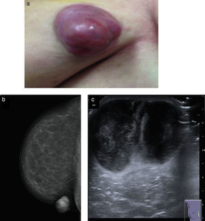 (a) Well-circumscribed, multilobe, nodular tumor. (b) Right breast mammography: dense, well-circumscribed, nodular lesion with a cutaneous cover, that is not associated to calcifications or alterations of the breast architecture. (c) Ultrasound: two adjacent heterogeneous, nodular masses that on the whole, measure 32×36×48mm.