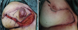 (a) Surgical resection with wide margins. (b) An inferior rotation oncoplasty.