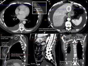 Imágenes de tomografía computarizada (TC) de mayo del 2016. Fibroadenoma mamario, adenopatías mediastínicas, micronódulo hepático, ascitis y derrame pleural bilateral de predominio derecho.