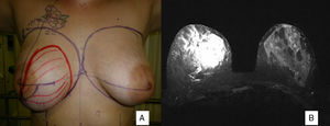 A) Mujer diagnosticada de angiosarcoma mama derecha. Marcaje prequirúrgico. B) Resonancia magnética: tumoración de aspecto vascular y alta sospecha en mama derecha (75×60×48mm), sin presencia de adenopatías. Categoría BIRADS 5.