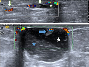 A. Probable papiloma benigno (PB). Hallazgo ecográfico más frecuente y característico de PB. Paciente de 43 años con secreción uniorificial de mama izquierda. En la ecografía se apreció una lesión ecogénica con flujo doppler-color (flechas blancas) en el interior de un ducto dilatado (estructura tubular anecoica) que se correspondía con el ducto secretor, cercano al pezón (estrella). Hallazgo BIRADS 3. La BAV confirmó el diagnóstico de PB. B. Probable PB intraquístico. Hallazgo ecográfico poco frecuente pero característico de PB. Paciente de 53 años que acudió por nódulo palpable periareolar de mama derecha. La ecografía mostró una lesión quística con contenido espeso (estrella azul) sobre líquido menos espeso, anecoico (estrella blanca). En la pared superior del quiste se apreció un nódulo ecogénico con flujo doppler-color (sólido), característico de un PB intraquístico (flecha azul). Hallazgo BIRADS 3. La BAV confirmó el diagnóstico de PB.