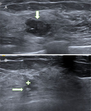 A. Papiloma atípico (PA). Paciente de 54 años con nódulo no palpable en la mama izquierda que se detectó en mamografía y ecografías de cribado. La ecografía mostró un nódulo sólido (hipoecogénico) de contornos polilobulados, parcialmente bien circunscrito, hallazgo BIRADS 4A. El diagnóstico de sospecha fue de fibroadenoma. La BAG obtuvo el diagnóstico de PA. La extirpación con BAV confirmó el diagnóstico de PA. B. Cicatriz con marcador. Control ecográfico a los 35 meses. La ecografía mostró un área irregular hipoecogénica (cruz blanca), estable desde el primer control a los 2 meses, relacionada con la fibrosis secundaria a la BAV. En el interior de la cicatriz se objetiva el marcador metálico (flecha) que se colocó después de la BAV para facilitar la localización del lecho de la biopsia por si el resultado hubiese sido un carcinoma papilar.