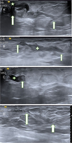 A. Probable PB. Paciente de 60 años con secreción uniorificial por el pezón izquierdo. La ecografía mostró un probable PB de 29mm de longitud (flechas blancas), cercano al pezón (estrella). Se extirpó con BAV, obteniendo el resultado de PB. B. Cicatriz post-BAV. En el control ecográfico al mes se apreció un área lineal hipoecogénica de contornos irregulares (cruz, limitada por las 2 flechas), relacionada con la cicatriz en evolución. No se objetivaron lesiones residuales. C. PB recidivante. El control ecográfico a los 22 meses mostró un nódulo sólido de 4mm (flecha) en el interior de un ducto dilatado (cruz), congruente con un probable PB recidivante. La paciente permanecía asintomática, ya que la secreción cedió después de la BAV. Se realizó una BAV de rescate y se confirmó el diagnóstico de PB. D. Control ecográfico a los 30 meses. La ecografía mostró un área lineal ecogénica de contornos irregulares (limitada por las 2 flechas), relacionada con la cicatriz de las 2 BAV previas, sin signos de papiloma residual.