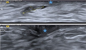 A. Papiloma atípico. Paciente de 40 años con secreción uniorificial de mama derecha. La ecografía mostró un probable PB (señalado por las cruces amarillas) dentro del ducto secretor dilatado, cercano al pezón (estrella azul). Hallazgo BIRADS 3. Se extirpó con BAV y el diagnóstico histológico fue de PA. B. Ecografía de control a los 26 meses. Se objetivó el área de la biopsia previa cercana al pezón (estrella azul), sin signos de lesión recidivante. Los cambios cicatriciales de la BAV previa no eran visibles. La secreción desapareció después de la BAV.