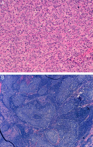 A) Carcinoma ductal infiltrante NOS (hematoxilina eosina, 20×). B) Carcinoma con rasgos medulares (hematoxilina eosina, 4×).