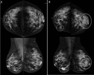 A) Mamografía bilateral en la que se aprecia un nódulo oval (flecha) de margen circunscrito e igual densidad que el tejido adyacente. B) Mamografía bilateral con asimetría en desarrollo retroareolar en mama izquierda (círculo continuo) y nódulo de morfología irregular, margen oscurecido y alta densidad en CII de mama derecha (círculo discontinuo).