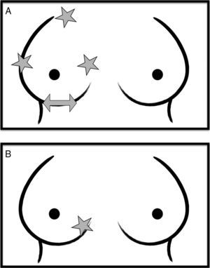 Las estrellas marcan los puntos ciegos cuando las lesiones son posteriores. A) En la proyección craneocaudal: el extremo superior, externo e interno de la mama. B) En la proyección MLO: el extremo inferointerno. La flecha en A señala el otro punto ciego de la proyección craneocaudal: el tejido del pliegue inframamario.