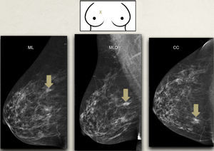 Correlación mamografía-exploración física-ecografía: se representa en el dibujo superior una lesión (X) en el cuadrante superointerno de la mama derecha y debajo su representación en las proyecciones mamográficas. Al estar en cuadrantes internos, la lesión aparece más inferior en la proyección MLO que en la ML. CC: craneocaudal; ML: mediolateral: MLO: mediolateral oblicua.