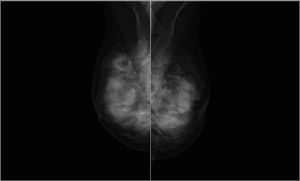 Mamografía bilateral. Proyección oblicua. Se objetivan mamas densas con ligera asimetría.