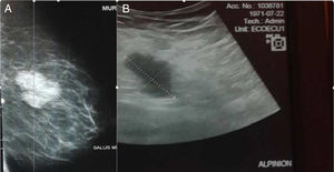 A) Mamografía que muestra masa de 3×2cm en mama izquierda. B) La ecografía describe una masa de 4,5×2,7cm en mama izquierda.