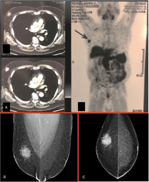 A) Tomografía (PET) de mama (cortes axiales). B) Mastografía bilateral que muestra tumoración densa localizada en el cuadrante superior externo de mama derecha. C) Mastografía bilateral en proyección cefalocaudal: se visualiza en mama derecha masa de categoría BIRADS 4b.