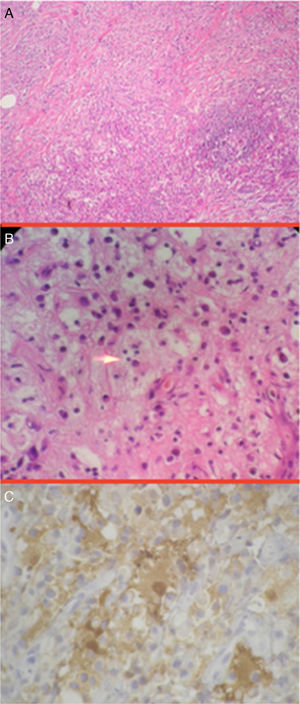 A) Lesión nodular infiltrativa con tejido fibroso, agregados de células linfoides, células plasmáticas e histiocitos vacuolados con emperipolesis (H&E, 200x). B) Histiocitos vacuolados con emperipolesis de linfocitos pequeños (flecha) rodeados por tejido fibroso y células plasmáticas (H&E, 400x). C) Histiocitos positivos con proteína S-100, emperipolesis linfocítica (600x).