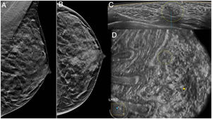 Mamografía en proyecciones oblicua y craneocaudal (A y B) en una paciente de 36 años, con un aumento de densidad con microcalcificaciones en el cuadrante superointerno. La lesión se identifica en el plano axial de ABUS como un nódulo con microcalcificaciones (C) y como un «agujero negro» en el plano coronal (D). El resultado histológico fue de neoplasia intraductal de alto grado.